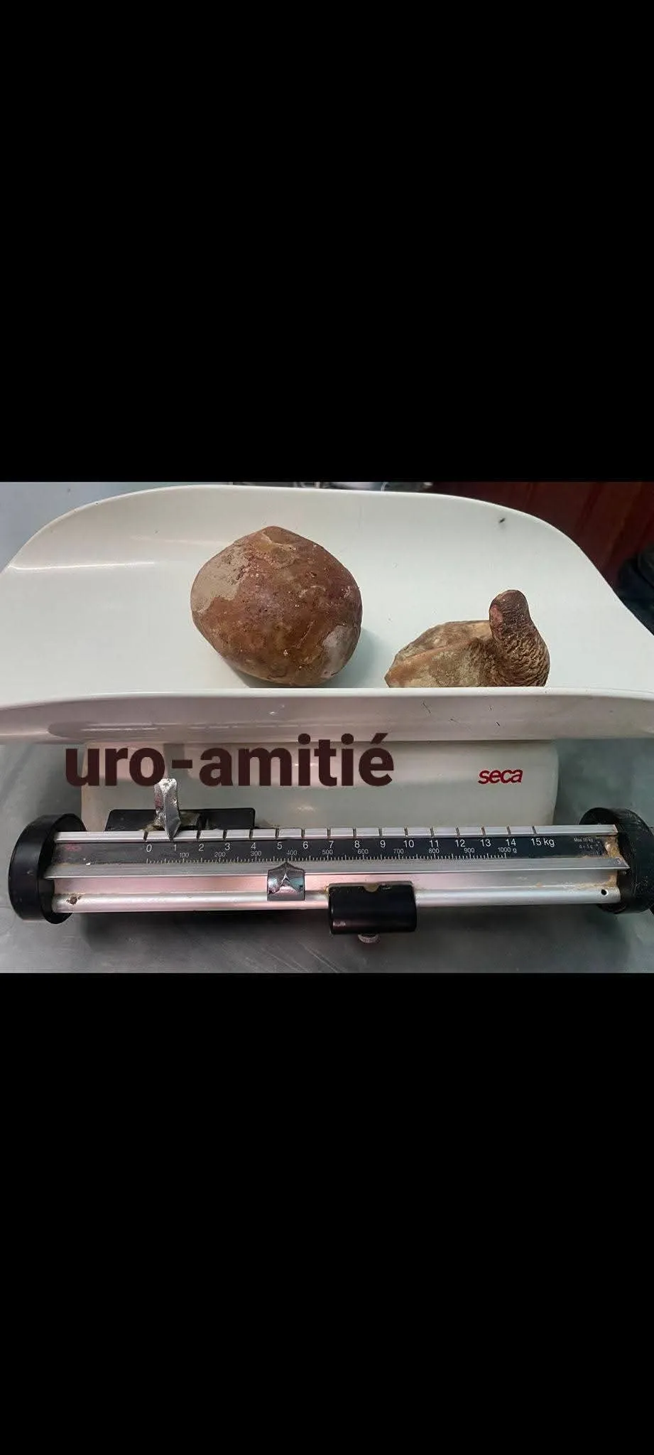 استئصال حصاتي مثانة بوزن 1.5 كلغ بمستشفى الصداقة