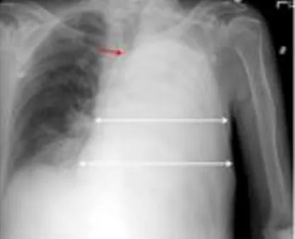 أكثر من ألفي مصاب بالسل في موريتانيا